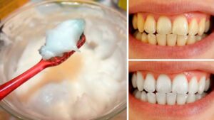 How To Naturally Whiten Your Teeth At Home In Just 3 Minutes Using 